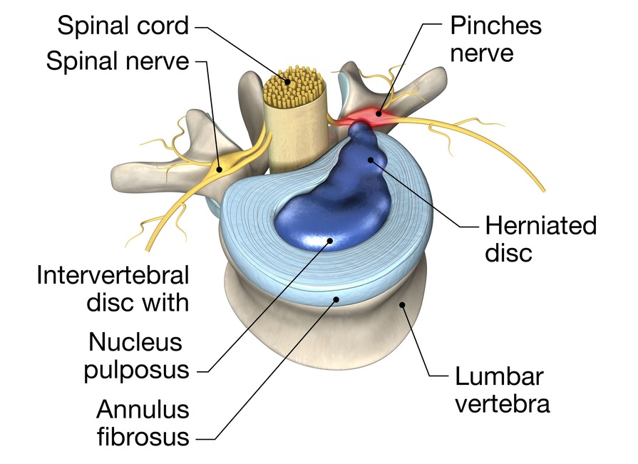 Inicio 13 Dibujo Hernia Discal
